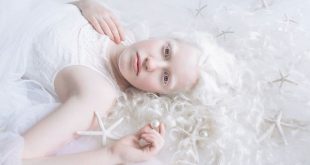 عکاسی از مبتلایان به زالی